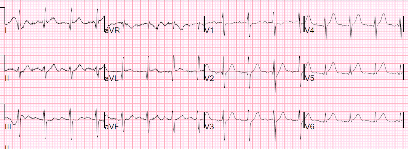 Dr Smith S Ecg Blog Lateral Hyperacute T Waves In V5 And V6