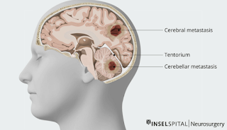 Brain Metastases in Lung Cancer: The Neurosurgical Approach
