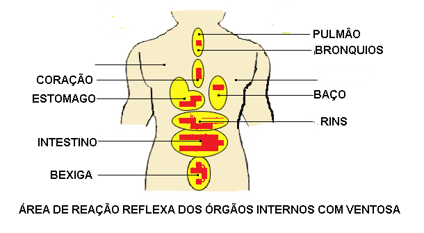 ventosa locais de aplicação