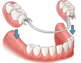 Chi phí làm răng giả tháo lắp