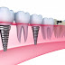 Độ an toàn của việc cấy ghép răng implant là gì?