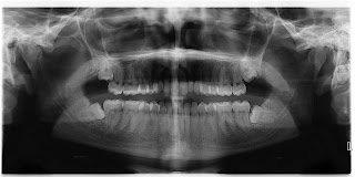 What is Impacted Wisdom Teeth