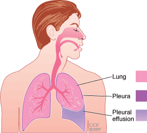 Nursing Diagnosis for Pleural Effusion Nursing Diagnosis for Pleural Effusion