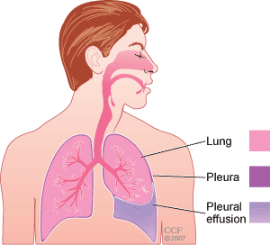 Nursing Diagnosis for Pleural Effusion