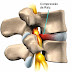 Tratamento de hérnia discal sem cirurgia