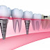 Chăm sóc răng miệng sau khi cấy ghép implant