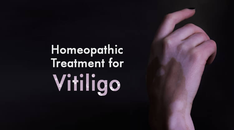 Vitiligo and Homeopathic Treatment