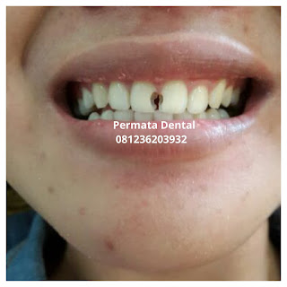 gambar foto contoh sebelum dan sesudah veneer gigi kelinci buatan manis cantik bali jember banyuwangi murah berkualitas di PERMATA DENTAL gambar gigi rusak yang di veneer gigi yang tidak rapi gigi renggang gigi patah cuil rompal pendek karies hitam kuning