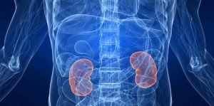  How to Dissolve Kidney Stones. 