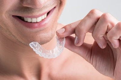 Tìm hiểu niềng răng không mắc cài 3D Clear 