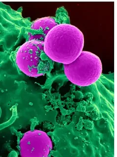 What is vaginal yeast infection icchori_Webp