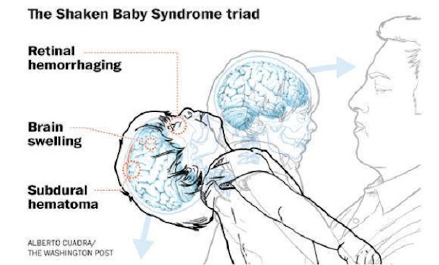 bayi lebih mudah mendapat pendarahan otak sekiranya digoncang