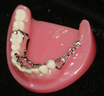 Phương pháp cho những người bị mất nhiều răng