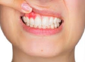 how to properly paste the gums which are festering