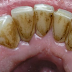 Vrlo jednostavno i efikasno: Kako ukloniti kamenac sa zuba bez odlaska kod zubara!