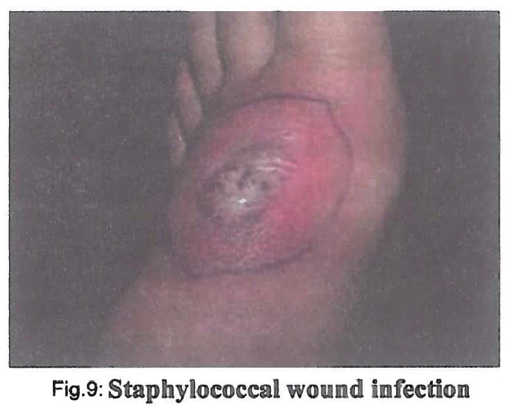 staphylococcal wound infection