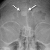 Frontal Sinus Osteoma Right, Left, Complications, Treatment