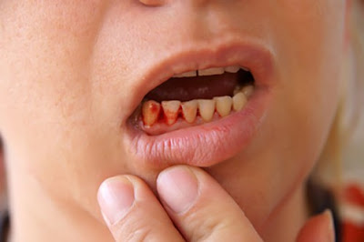 Vì sao bị viêm lợi chảy máu chân răng?