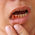 Vì sao bị viêm lợi chảy máu chân răng?