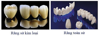 Tham khảo một số loại răng sứ đẹp