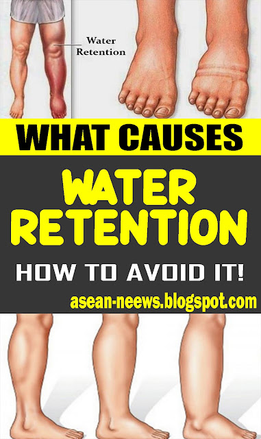 WHAT CAUSES WATER RETENTION AND HOW TO AVOID IT