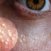 Supprimez le milium (acné miliaire) de votre visage grâce à ces remèdes naturels