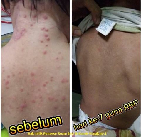 Penyakit Psoriasis,Ekzema,Ruam Bayi Dan Semua Penyakit 