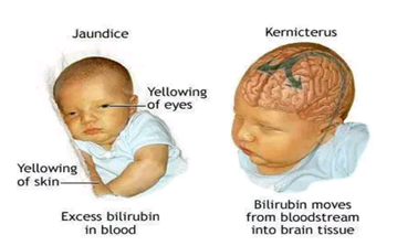 illustration of a neonate suffering from Jaundice and Kernicterus.