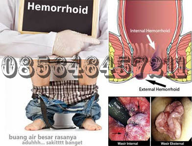 Harga Obat Antihemoroid AmbeJoss Obat Wasir