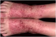 RAMUAN OBAT ALAMI UNTUK EKSIM MENAHUN DI KAKI