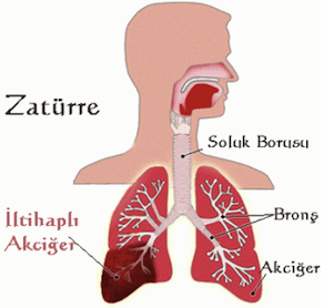 sağlık önerileri, yaz hastalıkları, yaz zatürre, zattüreden korunma, zatürre,