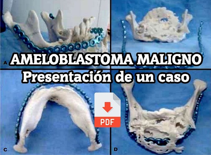 PDF: Ameloblastoma maligno. Presentación de un caso