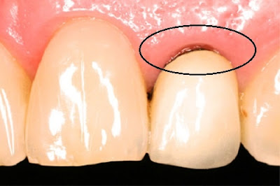 Giải đáp răng sứ titan có bị đen sau thời gian sử dụng không?