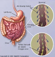 Atasi Diare Dengan Cara Jitu