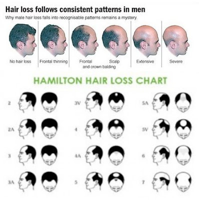 Male Androgenic Hair Loss Pattern