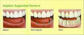 dental implants on dentures at dental care Bellevue