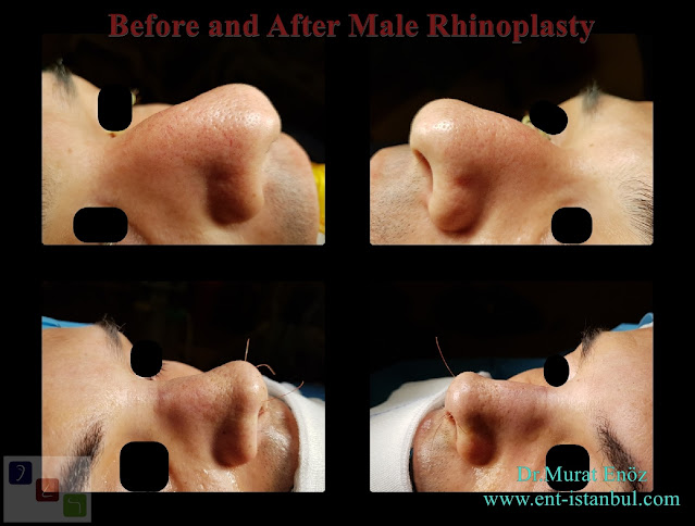 Male Rhinoplasty in Istanbul, Natural nose job for men, Male nose aesthetic surgery in Turkey