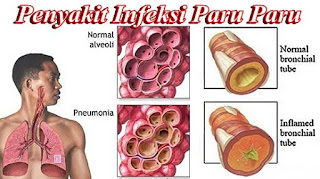 Penyakit Infeksi Paru paru Penyakit Infeksi Paru paru