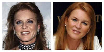 Sarah Ferguson Plastic Surgery