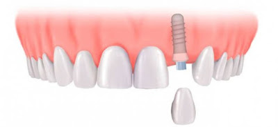 Cấy ghép răng Implant là như thế nào?