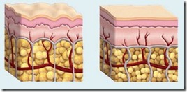 Cellulite_Solution