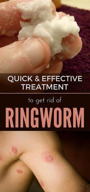 How to Get rid of Ringworm Fast and Forever