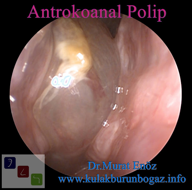 Antrochoanal Polyp