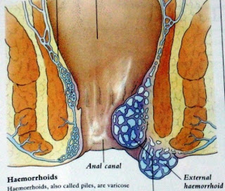 Bahan Herbal Untuk Obat Wasir Ampuh 