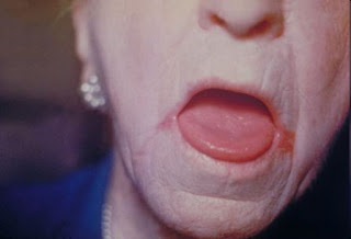 candidiasis mucosa