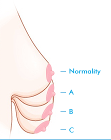 짱이뻐! - Korean Breast Plastic Surgery - Breast Lift