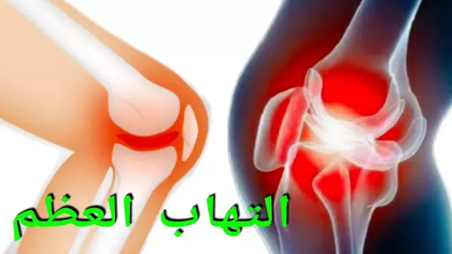 أعراض وعلامات التهاب العظم