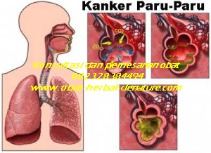 obat batuk paru,obat paru paru basah,obat batuk menahun,obat batuk TBC,obat batuk akibat rokok,obat batuk paru paru,obat paru paru bocor,obat batuk berlendir,obat batuk berdarah