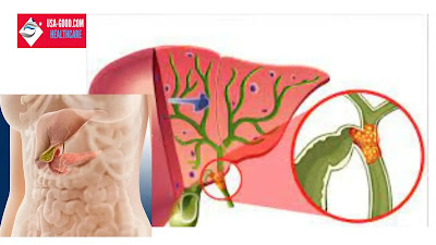 What is Cholangiocarcinoma (bile duct cancer)?
