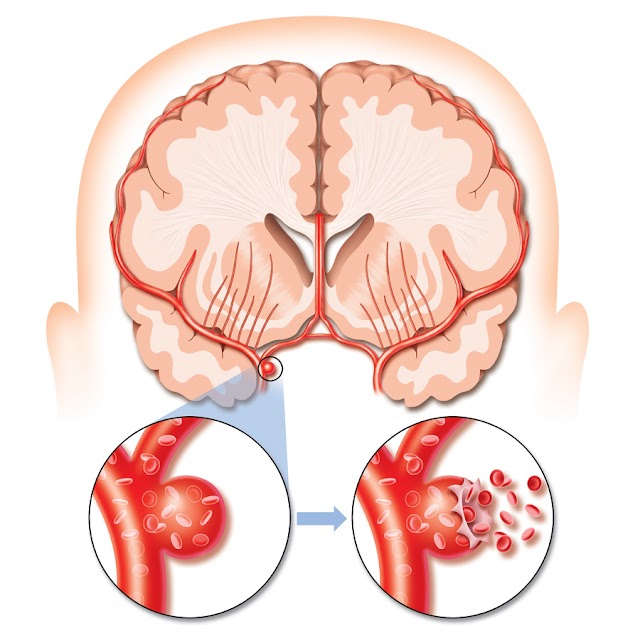 Nursing Management of Stroke